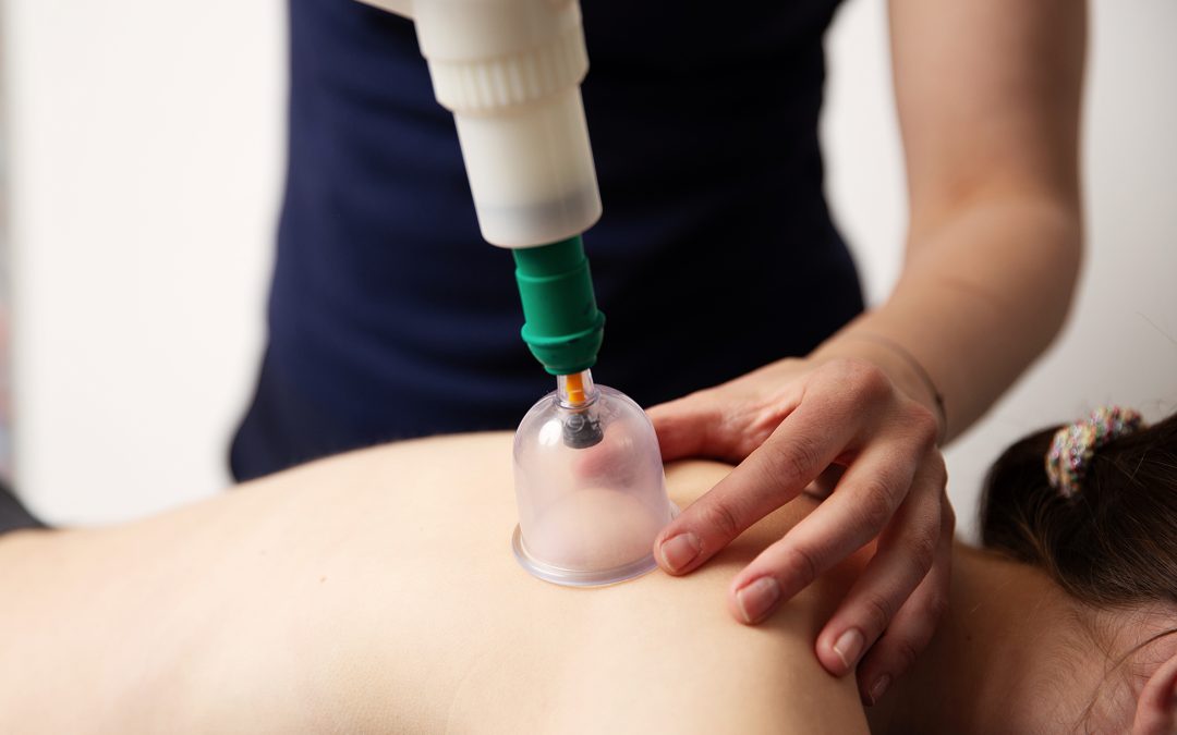 Cupping Therapy