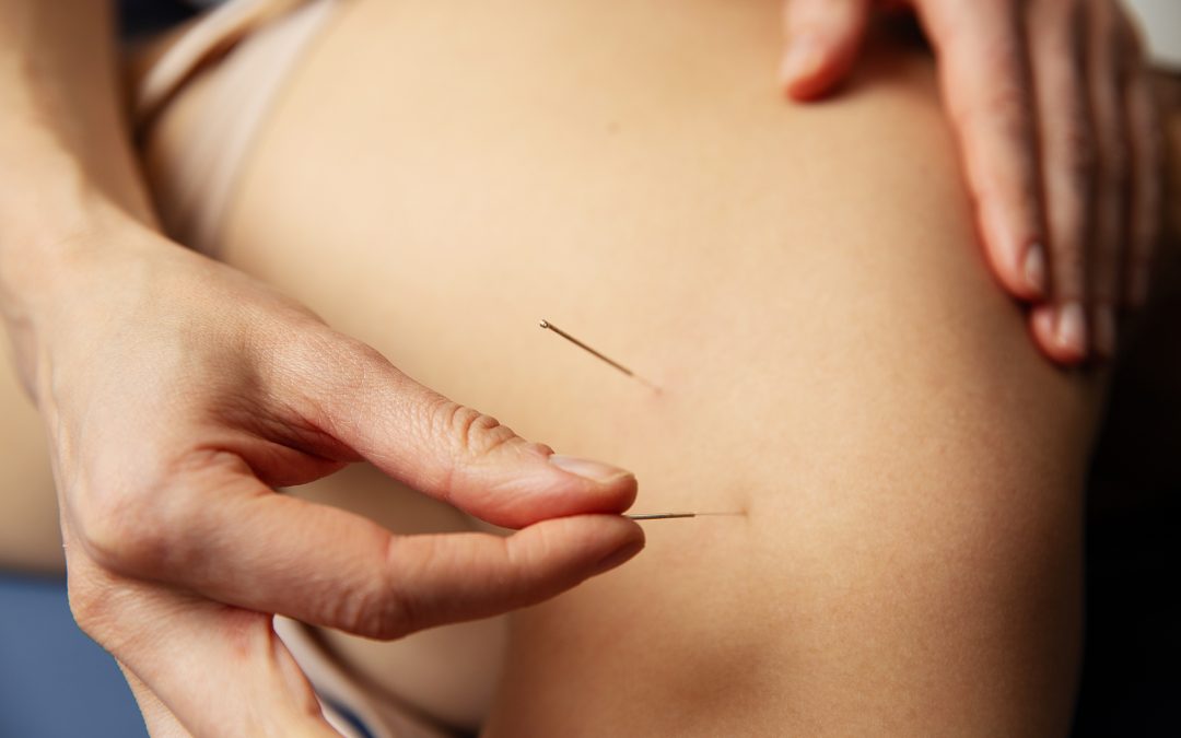 Dry Needling